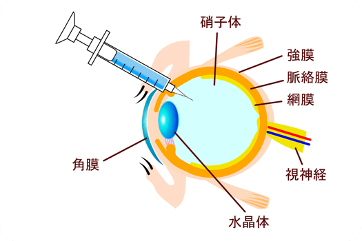 硝子体注射